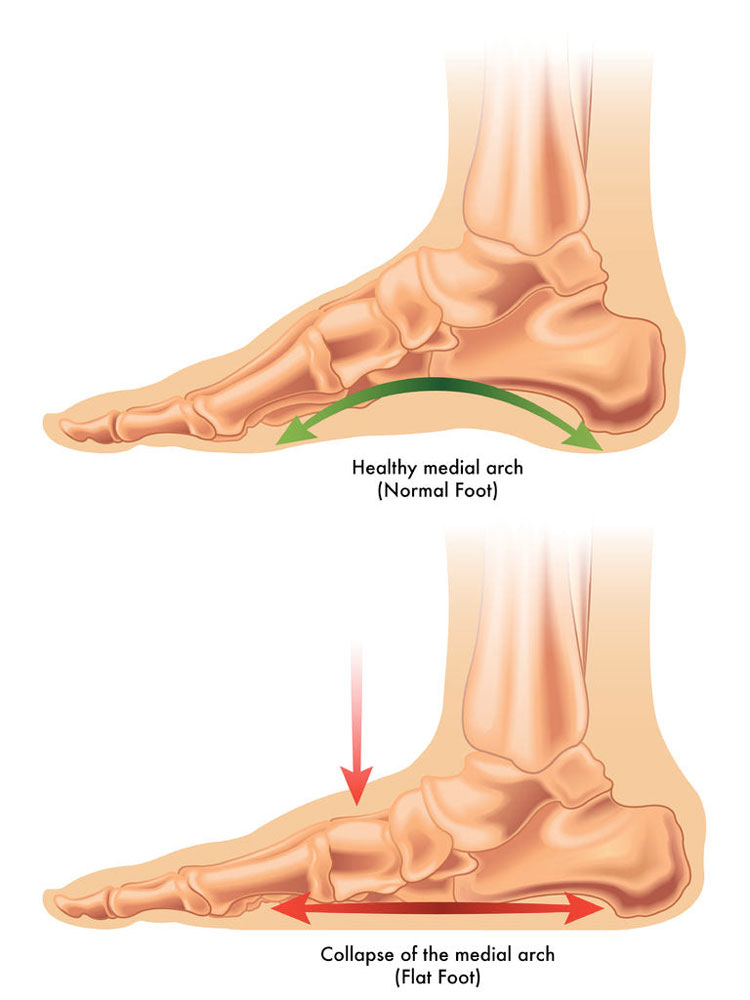 What Causes Flat Feet?