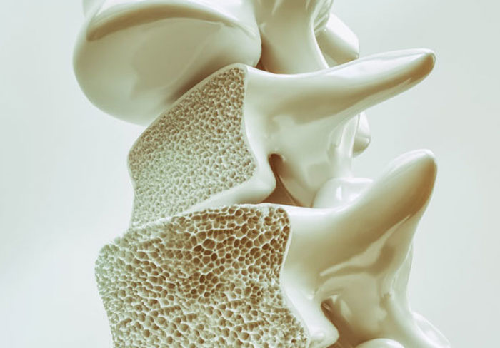 Osteoporosis: Diagnosis, and Treatment